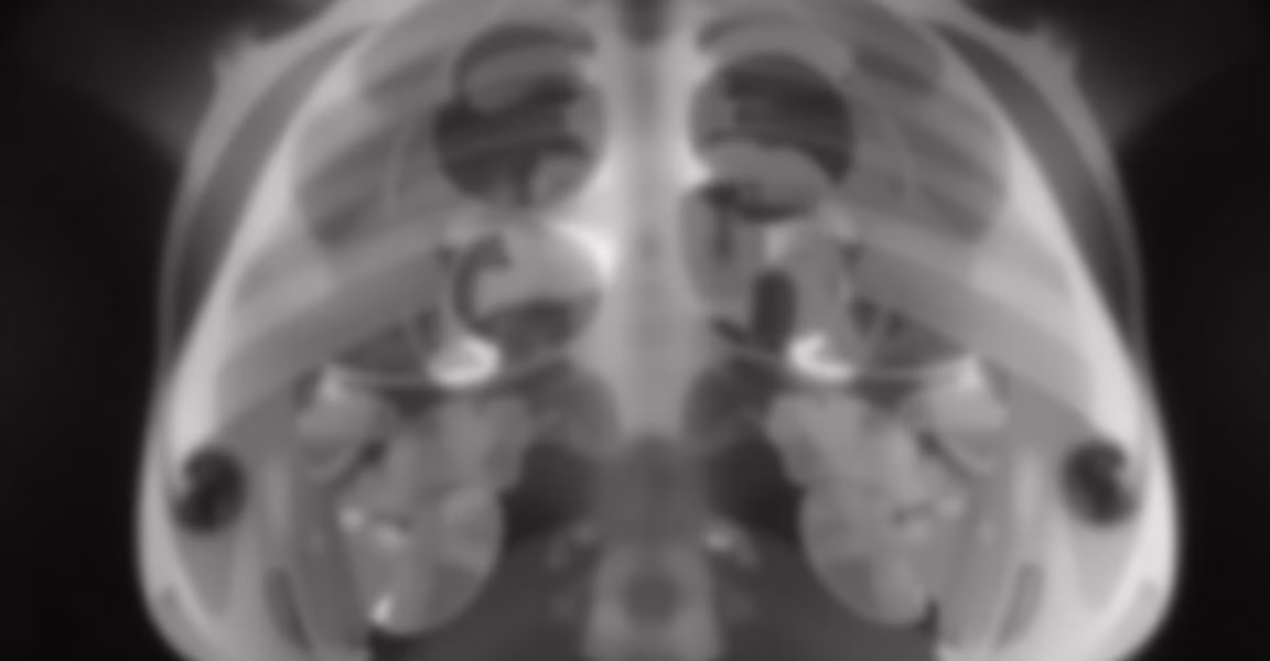 New Guidelines on Breast Cancer Screening for Women at Average Risk